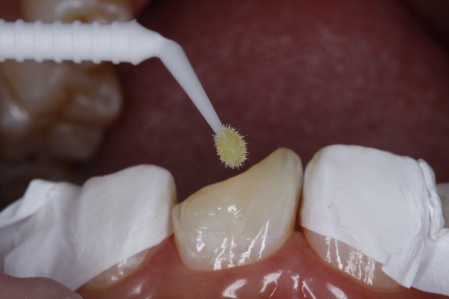 Fig 6: Application of FL-Bond II bonding system