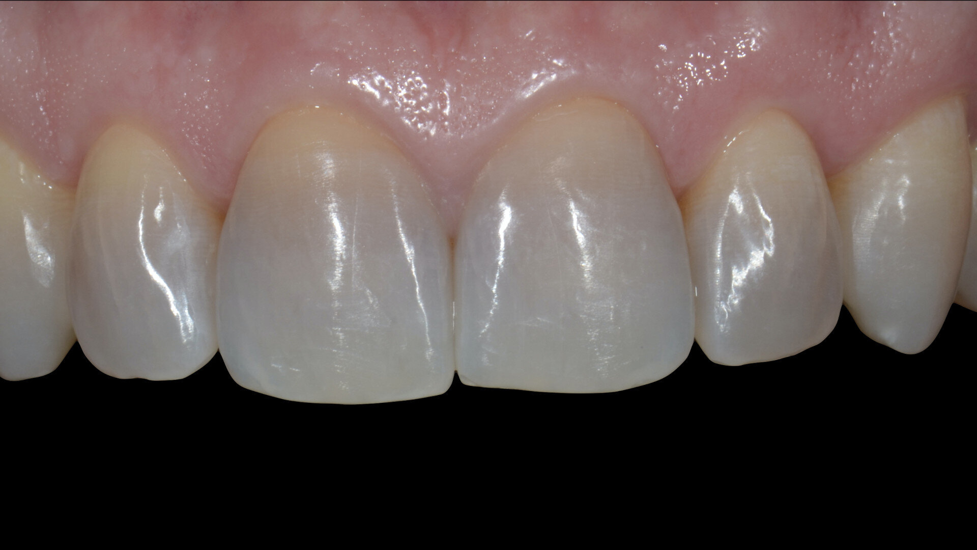 Aesthetic restoration of discoloured anterior teeth using feldspathic porcelain veneers