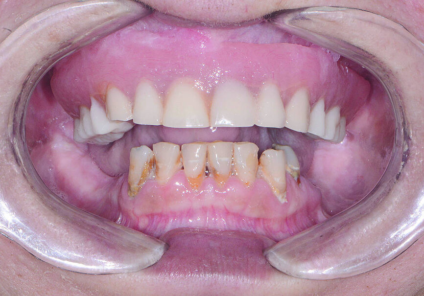 Fig 1 Vue préopératoire avec écarteur de lèvres