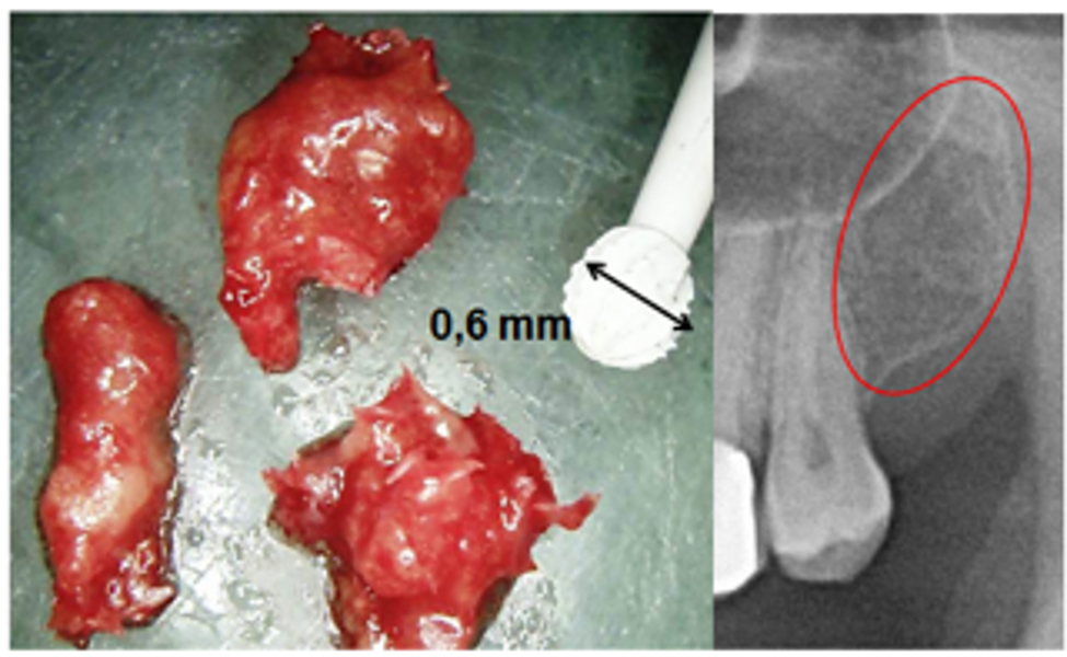 Fig. 5 : À gauche, échantillon de FDOJ avec une fraise boule céramique pour échelle. À droite, image panoramique correspondante à la zone curetée, qui semblait intacte sur la radiographie panoramique (© Dr Johann Lechner).