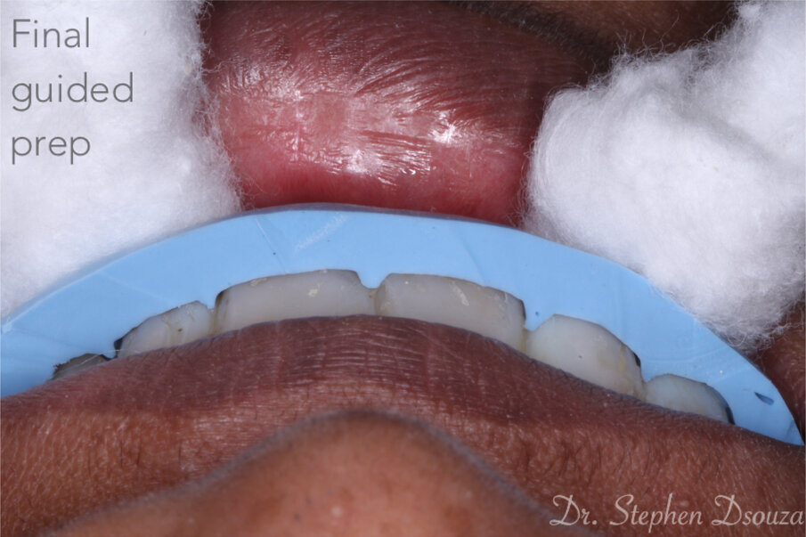 Fig. 8: Use of silicone indices to guide tooth preparation.