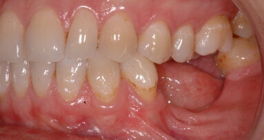 Soluzione di una grave atrofia ossea, orizzontale e verticale, con tecnica della lamina corticale