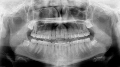 Optimal timing for management of impacted canines Optimal timing for management of impacted canines