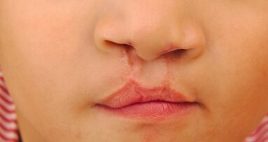 No link found between oral cleft surgery and cognitive impairment