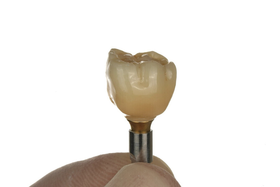 Fig. 11 & 12: Finished crown cemented to the Ti-base with a dual-polymerising resin cement.
