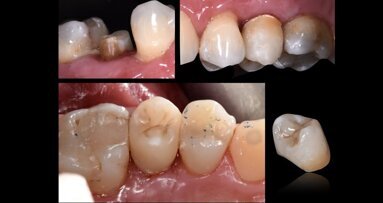 Un innovador poste radicular ayuda a preservar la sustancia dental