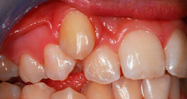 Espansione rapida del palato: terapia del deficit trasversale scheletrico del mascellare superiore