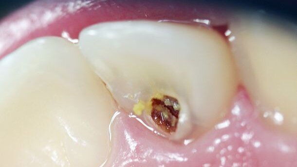 “Houd voorstadia van cariës goed in de gaten”