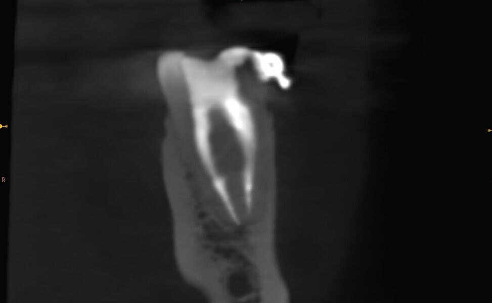 Figs. 39a & b: CBCT scan at the 12-month follow-up.