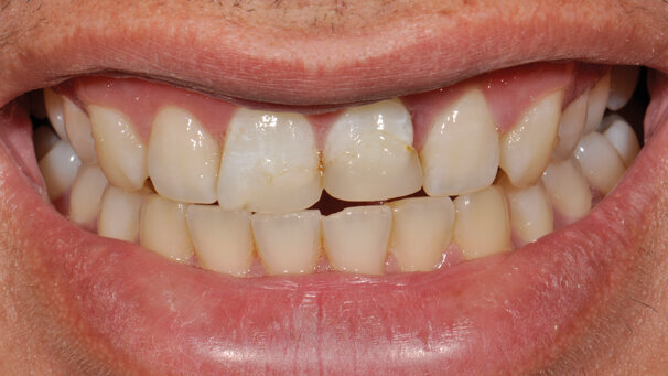 Trattamento biomimetico grazie a una scala colori intelligente modificabile in un caso post-trauma