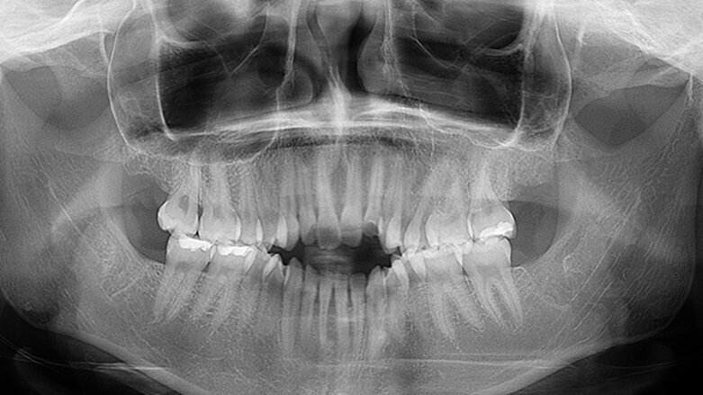 Intraorální skenery