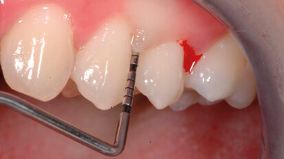 Terapia parodontale non chirurgica con approccio “One-Stage Full-Mouth Disinfection”