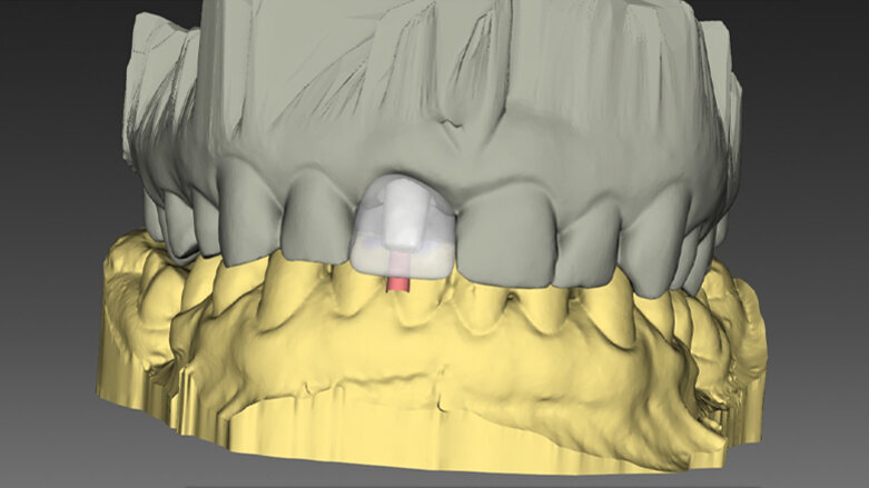 Využití současných technologií a digitálních řešení v okamžité jednodobé implantaci