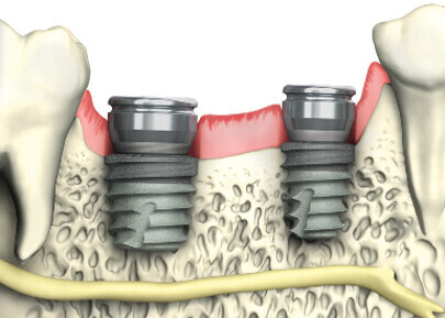 BioHorizons – Tapered Short