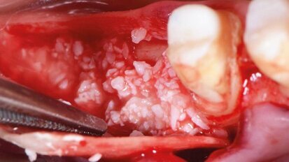 Implantologe beleuchtet knöcherne Augmentation mit GBR-Technik Implantologe beleuchtet knöcherne Augmentation mit GBR-Technik