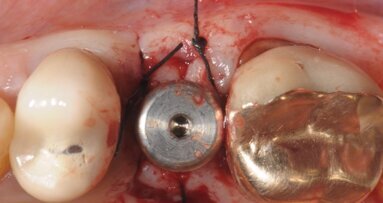 Impianto post-estrattivo, immediato o ritardato? Scelta razionale, tecnologicamente supportata