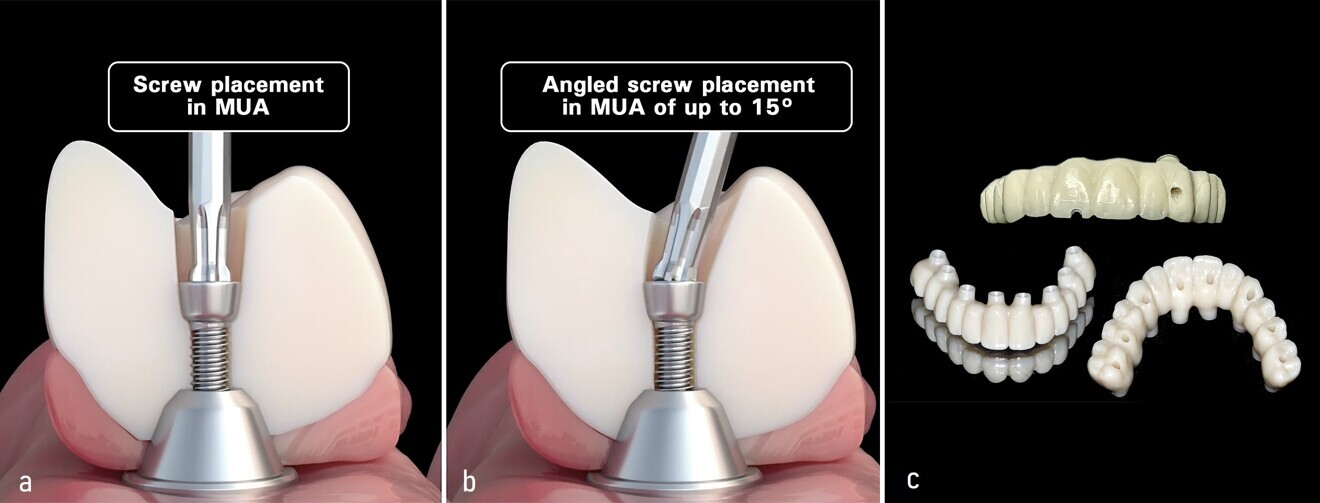 Figs. 8a–c: Straight screw access hole (a). Angled screw access hole of up to 15° (b). Straight vs angled screw access holes and variation in access hole positions for improved strength and aesthetics in multi-unit abutments (c).