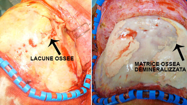 Gestione delle complicanze nella chirurgia  cranio-facciale