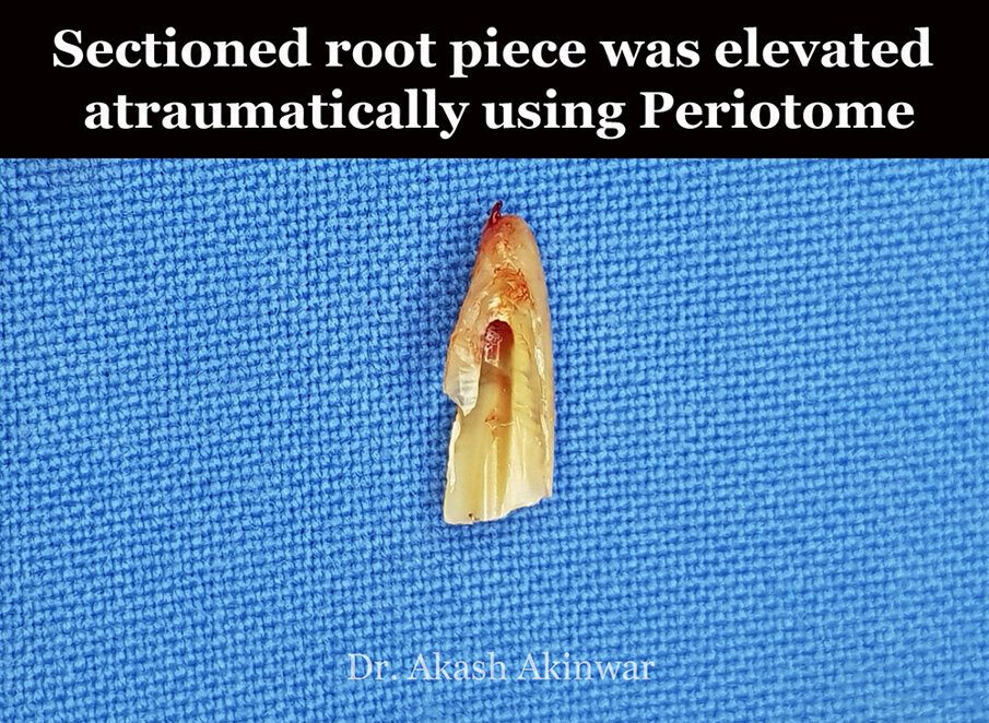 Fig 13: Removed palatal fragment