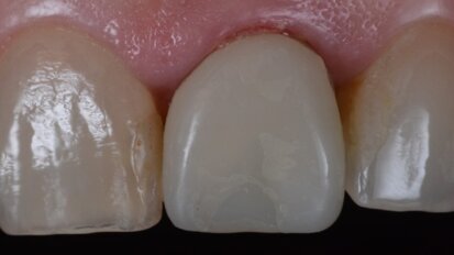 Carico immediato dell’impianto e restauro di incisivo fratturato