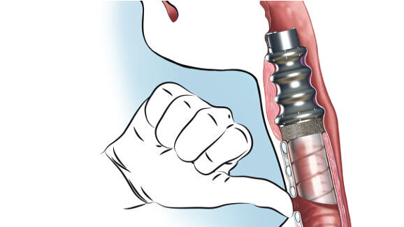 Implantation du premier larynx artificiel chez l’homme