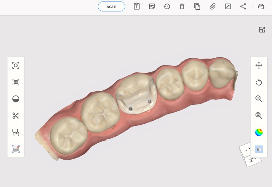 Fig. 13: Digitised model of the pinlay preparation on tooth #36 with the two dentine pins, captured using the Medit i600 scanner and Medit Link software.