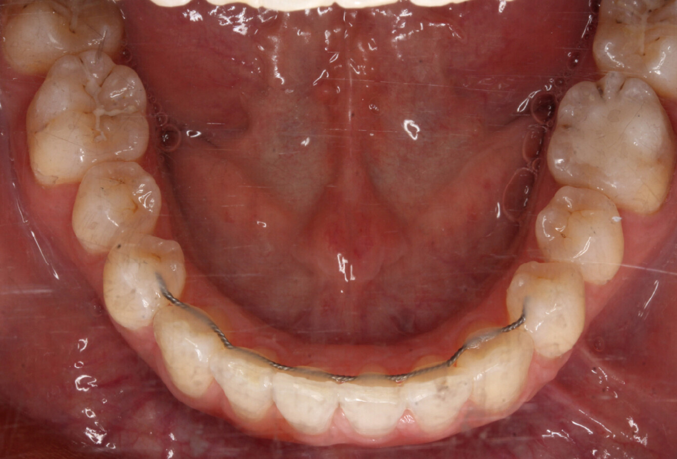Fig. 4d: Occlusal intra-oral view of the mandible. 