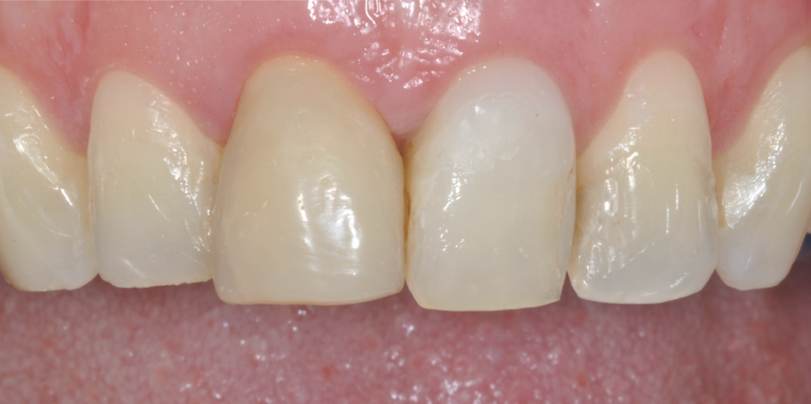 Fig. 8 - La guarigione a 4 mesi dalla chirurgia.