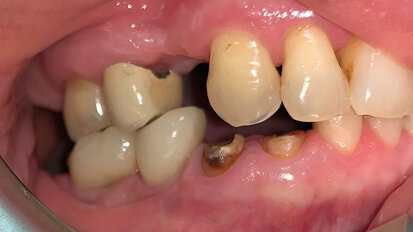 Fig. 1. Vista del caso preoperatorio Fig. 1. Vista del caso preoperatorio