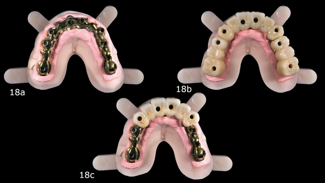 Figs. 18a–c: Hybrid definitive prosthesis composed of a CAD/CAM titanium bar and three zirconia prosthetic segments bonded on top.