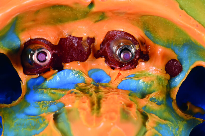 Fig. 30: Implant level impression.