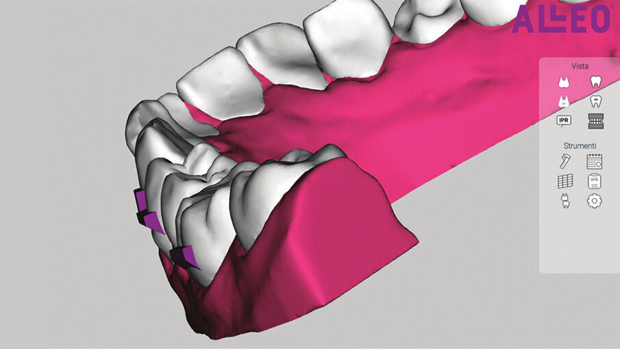 Figg. 5a-5c_View ALLEO ci permette la visualizzazione del set-up, la quantità di stripping necessaria per ottenere un corretto allineamento, la posizione degli attachments, oltre al report biomeccanico preciso di tutti i movimenti dentali proposti all’interno del set-up.