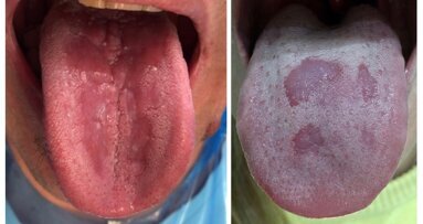 Manifestaciones orales más comunes de Covid-19