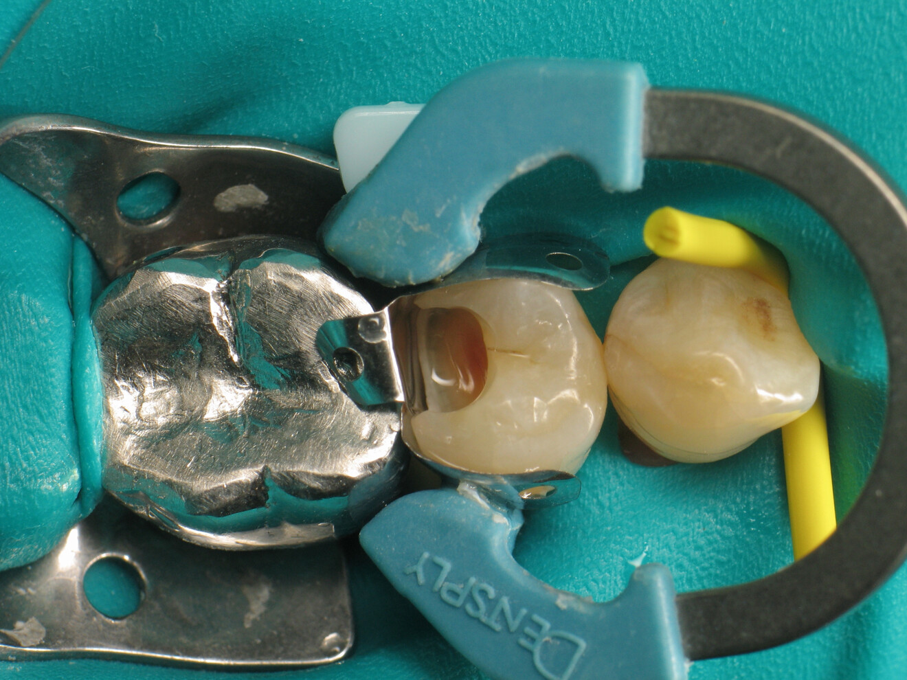 Fig. 7: Cavity after use of Telio Desensitizer.