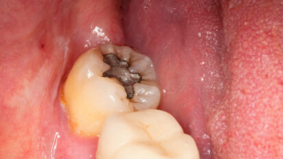 Certaines variantes génétiques peuvent entraîner une prédisposition à l'empoisonnement au mercure