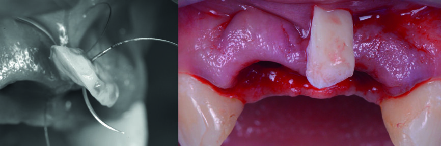 Fig. 17 : Greffe de tissu mou pour reconstruire la papille entre les incisives centrales. 
