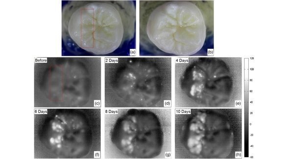 Aparelho de imagem de baixo custo pode facilitar a detecção precoce de cáries