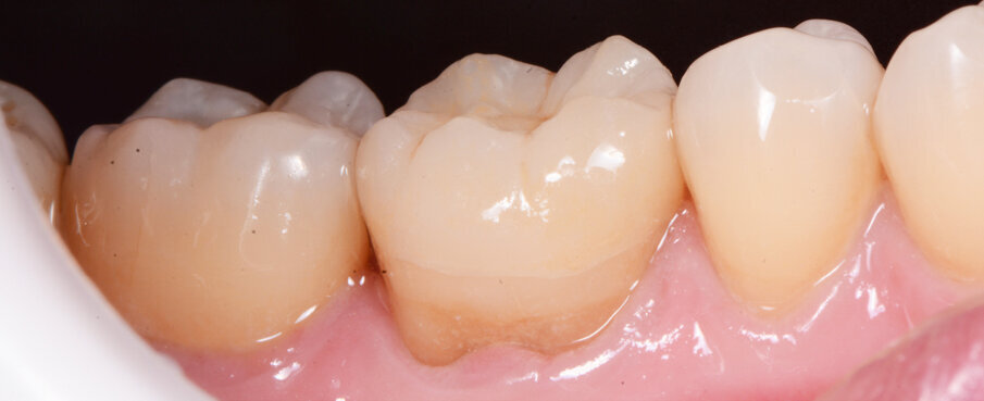 Fig. 12a: Lateral and occlusal view of the completed restoration