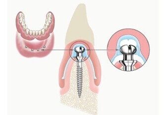Mini implants stabilize, cushion dentures — no adhesive needed Mini implants stabilize, cushion dentures — no adhesive needed