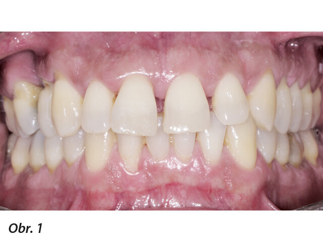 Obr. 1–5: Fotografi cká dokumentace počátečního stavu před parodontologickým ošetřením