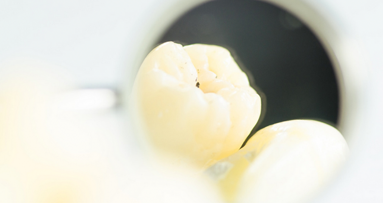 Können Probiotika ECC bremsen?