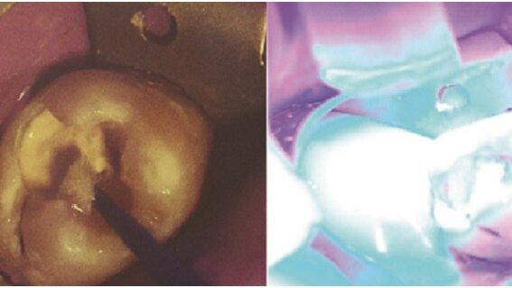 Biodentin „Jedan za sve“  -korak napred