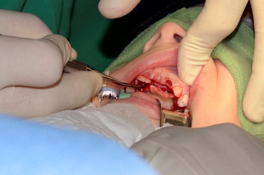 Fig. 7.  Exposure of the supernumerary tooth $ bulge palatally.
