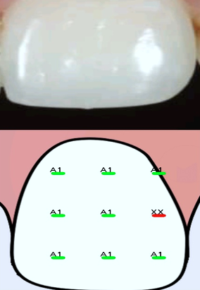 Mobile shade has less difficulty to identify the shade overall shade is A1