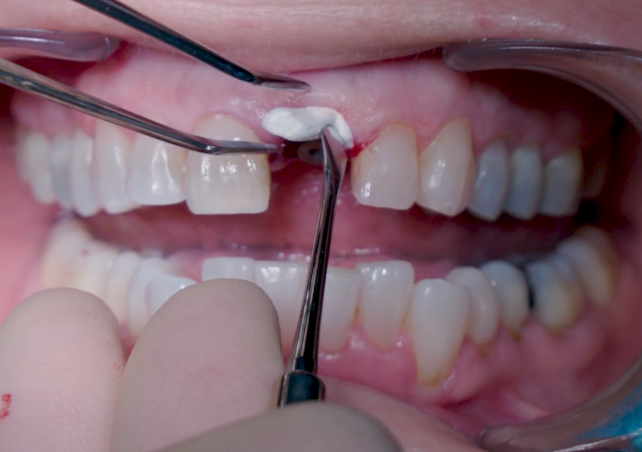 Fig. 17_ Applicazione del collacone (botiss biomaterials). 