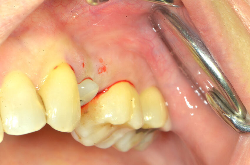 Fig. 12b_Il profilo di emergenza del profilo di emergenza rilocato.
