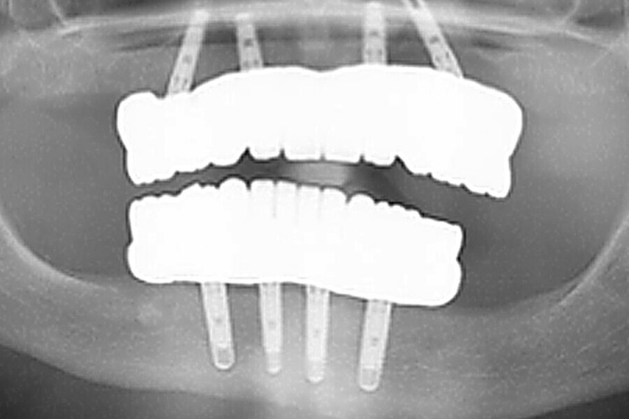 Fig. 29. Rx Pre-operatoria, Prótesis híbrida inmediata con 5 años de evolucion y Rx Control a los 5 años.