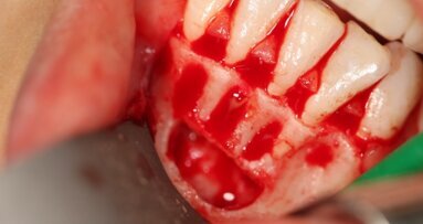 Leczenie chirurgiczne torbieli żuchwy – opis przypadków