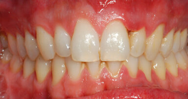 Gestione multidisciplinare del paziente affetto da gengivite ulcero-necrotica