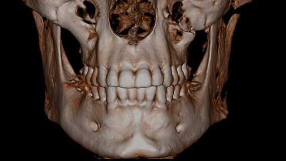 Résultats du sondage Cone beam